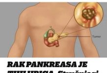 Rak gušterače je tihi ubojica. Stručnjaci podsjećaju da obratite pozornost na pet glavnih simptoma