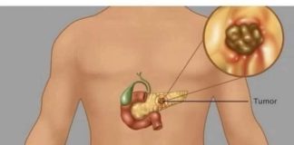 Rak gušterače je tihi ubojica. Stručnjaci podsjećaju da obratite pozornost na pet glavnih simptoma