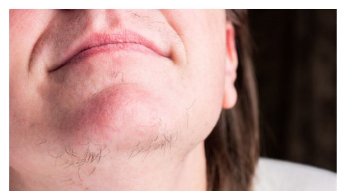 Jeste li se ikada zapitali o pojavi dlaka na bradi kod žena? Istražimo što vaše tijelo možda pokušava komunicirati.