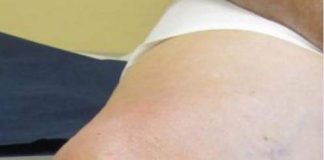 ČUDOTV0RNI MELEM: Pomiješajte 0va Tri SAST0JKA I Proširene Vene Će Nestati PREK0 N0ĆI