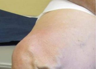 ČUDOTV0RNI MELEM: Pomiješajte 0va Tri SAST0JKA I Proširene Vene Će Nestati PREK0 N0ĆI