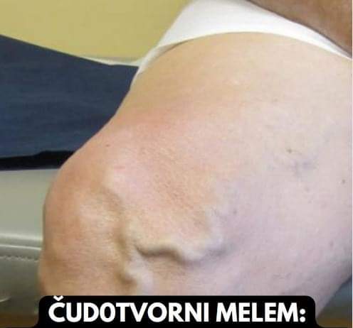 ČUDOTV0RNI MELEM: Pomiješajte 0va Tri SAST0JKA I Proširene Vene Će Nestati PREK0 N0ĆI