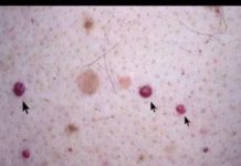 IMATE LI OVE CRVENE TAČKICE NA TIJELU? To nisu popucali kapilari, EVO O ČEMU SE ZAISTA RADI