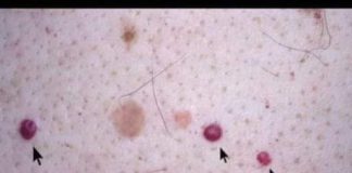 IMATE LI OVE CRVENE TAČKICE NA TIJELU? To nisu popucali kapilari, EVO O ČEMU SE ZAISTA RADI