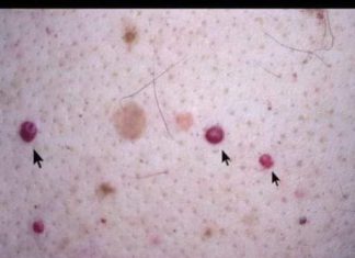 IMATE LI OVE CRVENE TAČKICE NA TIJELU? To nisu popucali kapilari, EVO O ČEMU SE ZAISTA RADI