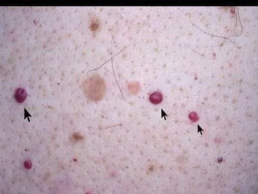 IMATE LI OVE CRVENE TAČKICE NA TIJELU? To nisu popucali kapilari, EVO O ČEMU SE ZAISTA RADI