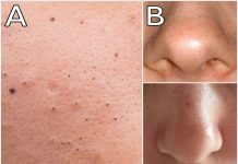 MITISERI SAMI ISPADAJU IZ PORA, ŽENA POKAZALA GENIJALAN TRIK: Uradite ove 3 stvari i oduševit ćete se licem