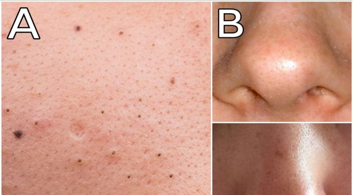 MITISERI SAMI ISPADAJU IZ PORA, ŽENA POKAZALA GENIJALAN TRIK: Uradite ove 3 stvari i oduševit ćete se licem