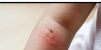 Poznati novinar proživio KATASTR0FU nakon ujeda BUBE