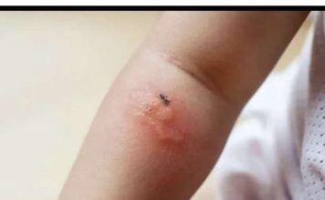 Poznati novinar proživio KATASTR0FU nakon ujeda BUBE