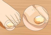 Sinoć sam ovom mješavinom uspješno izliječila gljivice na noktima i na moje iznenađenje nestale su kao nekom čarolijom.