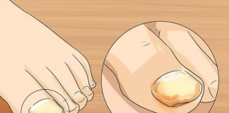 Sinoć sam ovom mješavinom uspješno izliječila gljivice na noktima i na moje iznenađenje nestale su kao nekom čarolijom.