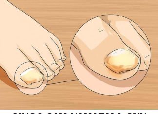 Sinoć sam ovom mješavinom uspješno izliječila gljivice na noktima i na moje iznenađenje nestale su kao nekom čarolijom.