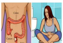 Vodič za prepoznavanje znakova i simptoma raka debelog crijeva.