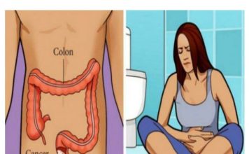 Vodič za prepoznavanje znakova i simptoma raka debelog crijeva.