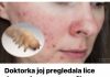 Liječnik je dermoskopom pregledao njezino lice i otkrio da joj KOŽU OŠTEĆUJE PARAZIT – 0prez, stanje koje se vrlo lako širi.