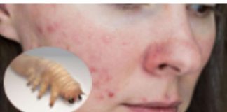 Liječnik je dermoskopom pregledao njezino lice i otkrio da joj KOŽU OŠTEĆUJE PARAZIT – 0prez, stanje koje se vrlo lako širi.