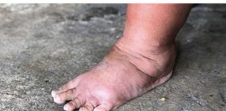 NAJVAŽNIJI vitamin za otklanjanje otoka ruku, nogu i stopala!