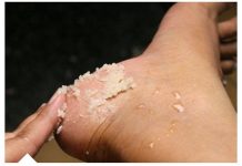 Svakako zapišite ovaj genijalni recept za liječenje grubih ruku, ispucalih peta, kurjeg oka, žuljeva i uraslih noktiju.