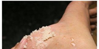 Svakako zapišite ovaj genijalni recept za liječenje grubih ruku, ispucalih peta, kurjeg oka, žuljeva i uraslih noktiju.