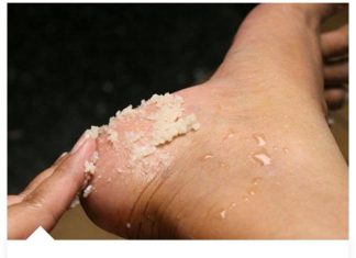 Svakako zapišite ovaj genijalni recept za liječenje grubih ruku, ispucalih peta, kurjeg oka, žuljeva i uraslih noktiju.