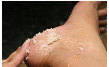 Svakako zapišite ovaj genijalni recept za liječenje grubih ruku, ispucalih peta, kurjeg oka, žuljeva i uraslih noktiju.