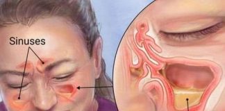 EVO BRZOG NAČINA ZA LIJEČENJE INFEKCIJE SINUSA: Pripremite ovaj domaći napitak i svjedočite ČUDU! (RECEPT)