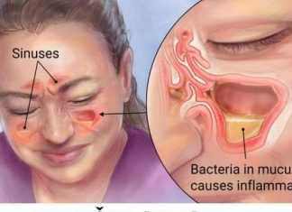 EVO BRZOG NAČINA ZA LIJEČENJE INFEKCIJE SINUSA: Pripremite ovaj domaći napitak i svjedočite ČUDU! (RECEPT)