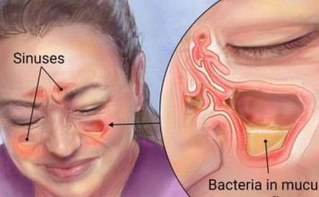 EVO BRZOG NAČINA ZA LIJEČENJE INFEKCIJE SINUSA: Pripremite ovaj domaći napitak i svjedočite ČUDU! (RECEPT)