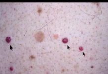 VIDITE LI OVE CRVENE TOČKE NA SVOJOJ KOŽI? Nije zbog popucalih kapilara; EVO PRAVE PRIČE IZA TOGA.