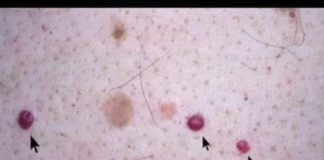 VIDITE LI OVE CRVENE TOČKE NA SVOJOJ KOŽI? Nije zbog popucalih kapilara; EVO PRAVE PRIČE IZA TOGA.