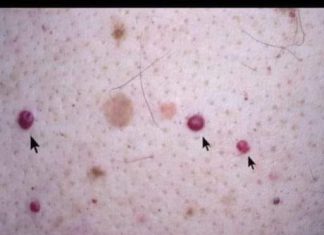 VIDITE LI OVE CRVENE TOČKE NA SVOJOJ KOŽI? Nije zbog popucalih kapilara; EVO PRAVE PRIČE IZA TOGA.