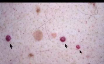 VIDITE LI OVE CRVENE TOČKE NA SVOJOJ KOŽI? Nije zbog popucalih kapilara; EVO PRAVE PRIČE IZA TOGA.