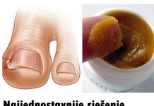 OVAKO JEDNOSTAVNO MOŽETE LIJEČITI URASLI NOKAT KOD KUĆE