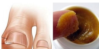 OVAKO JEDNOSTAVNO MOŽETE LIJEČITI URASLI NOKAT KOD KUĆE