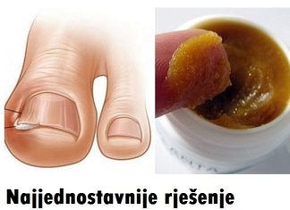 OVAKO JEDNOSTAVNO MOŽETE LIJEČITI URASLI NOKAT KOD KUĆE