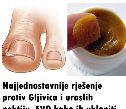 OVAKO JEDNOSTAVNO MOŽETE LIJEČITI URASLI NOKAT KOD KUĆE