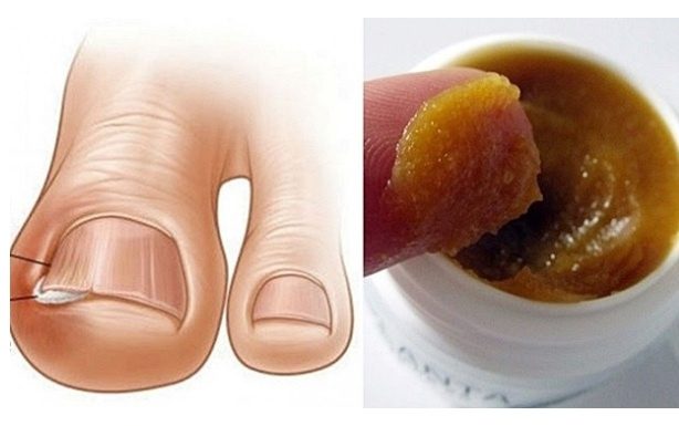 OVAKO JEDNOSTAVNO MOŽETE LIJEČITI URASLI NOKAT KOD KUĆE
