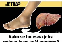 Kako se bolesna jetra manifestira na koži i nogama? OVO SU ZNAKOVI BOLESNE JETRE… (SLIKA)