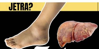 Kako se bolesna jetra manifestira na koži i nogama? OVO SU ZNAKOVI BOLESNE JETRE… (SLIKA)