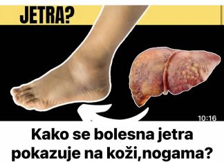 Kako se bolesna jetra manifestira na koži i nogama? OVO SU ZNAKOVI BOLESNE JETRE… (SLIKA)