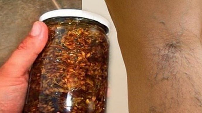 Namažite noge ovim uljem i više nikad nećete imati problema sa proširenim venama (Recept)