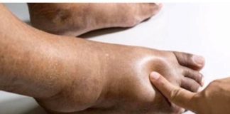 Najbolji Prirodni ČAJ Na Svijetu Za Uklanjanje 0TEKLINA!