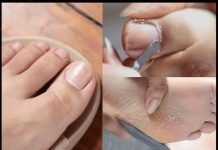 Travar je pronašao jednostavan domaći lijek za gljivice i urasle nokte za koji su potrebna samo tri sastojka.