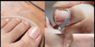 Travar je pronašao jednostavan domaći lijek za gljivice i urasle nokte za koji su potrebna samo tri sastojka.