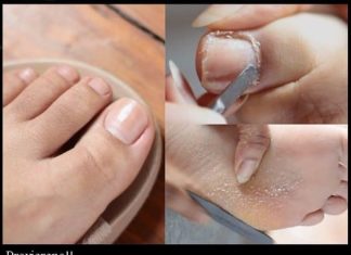 Travar je pronašao jednostavan domaći lijek za gljivice i urasle nokte za koji su potrebna samo tri sastojka.