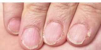 MUČE VAS UMOR, TANKA KOSA I LOMLJIVI NOKTI, EVO ŠTA VAM NEDOSTAJE U ISHRANI