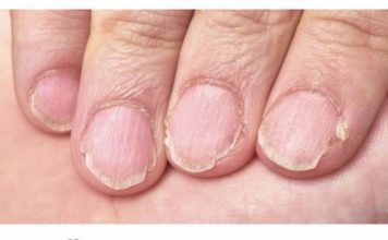 MUČE VAS UMOR, TANKA KOSA I LOMLJIVI NOKTI, EVO ŠTA VAM NEDOSTAJE U ISHRANI