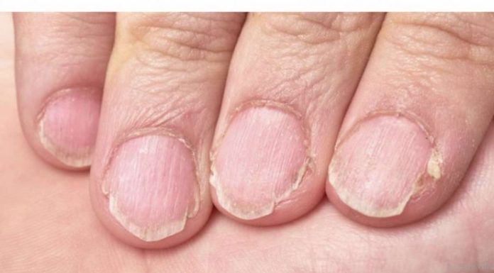 MUČE VAS UMOR, TANKA KOSA I LOMLJIVI NOKTI, EVO ŠTA VAM NEDOSTAJE U ISHRANI