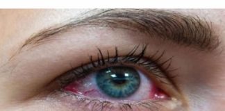 Simptom koji ne smijete zanemariti: Popucale vene u oku mogu biti PRVI ZNAK ozbiljne bolesti.